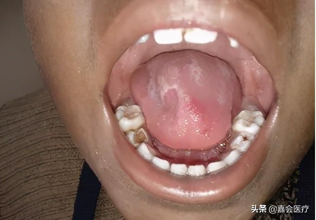 地图舌苔是什么原因引起的（儿童地图舌需要治疗吗）