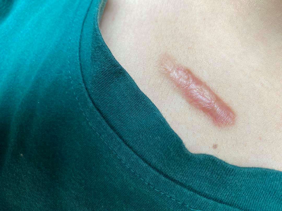 什么是疤痕体质（解释疤痕体质的概念和特点）