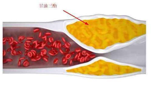 三脂高指的是哪三种脂质（三脂高指的是哪些脂质）