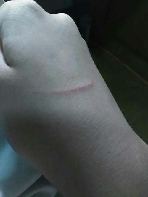 猫抓伤感染判断方法（被猫抓伤后如何判断是否感染）