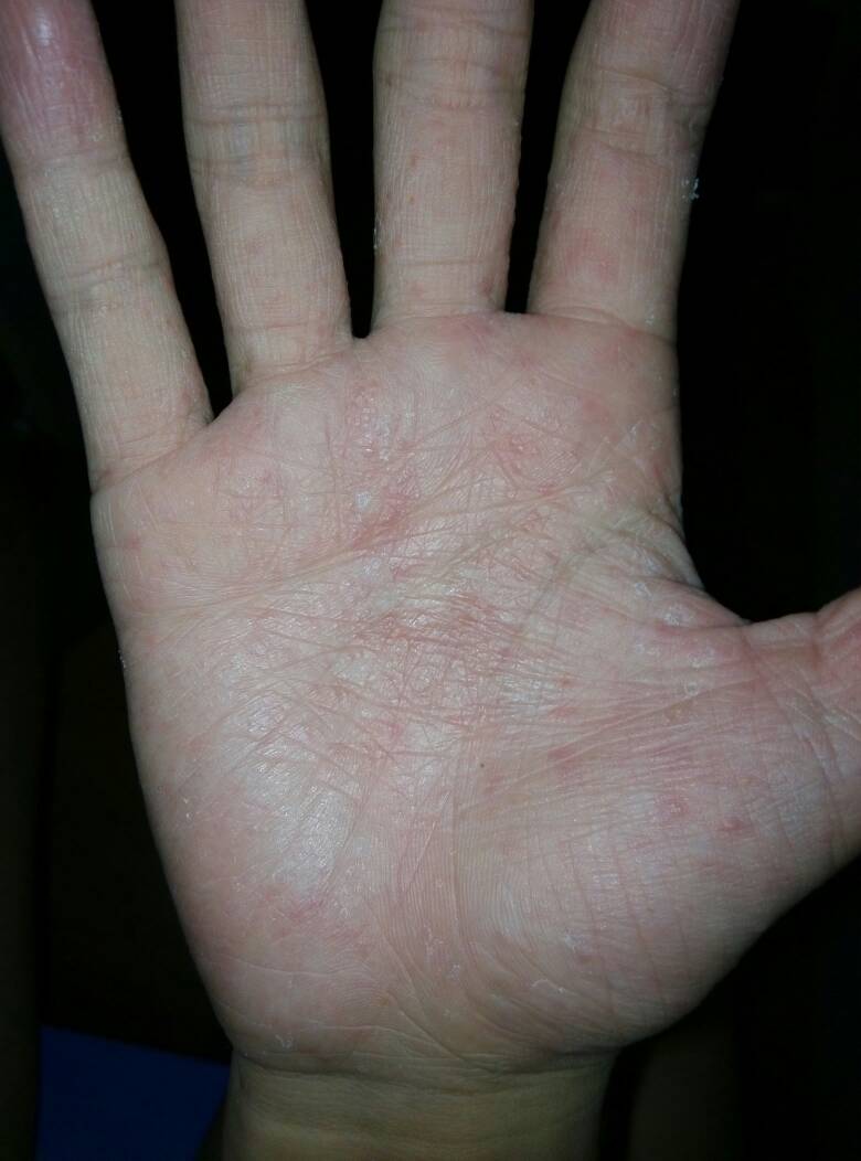 手脚发痒是怎么回事（探究手脚发痒的原因）