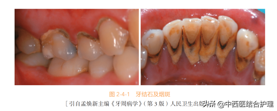 牙结石有什么危害（什么是牙结石长什么样应该怎么去除）